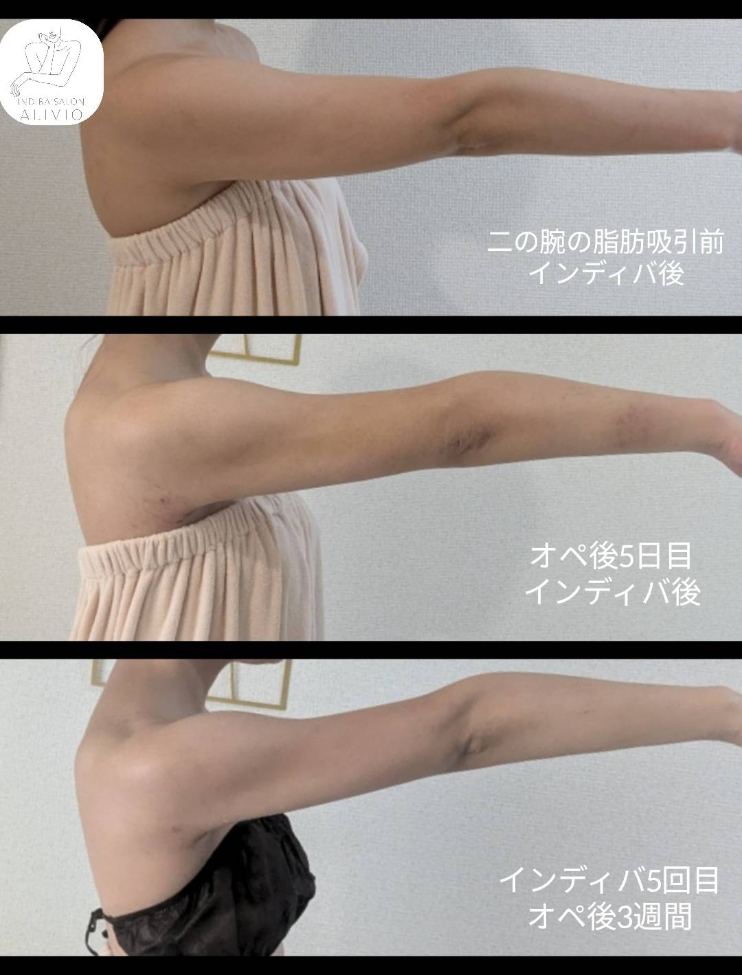 インディバで深部からアプローチ