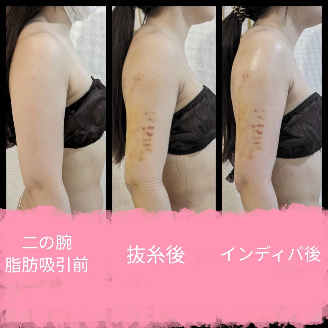 リンパマッサージでむくみ解消