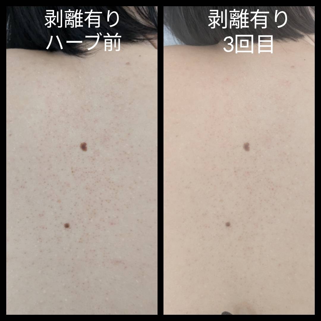 3. 施術後のビフォーアフター紹介