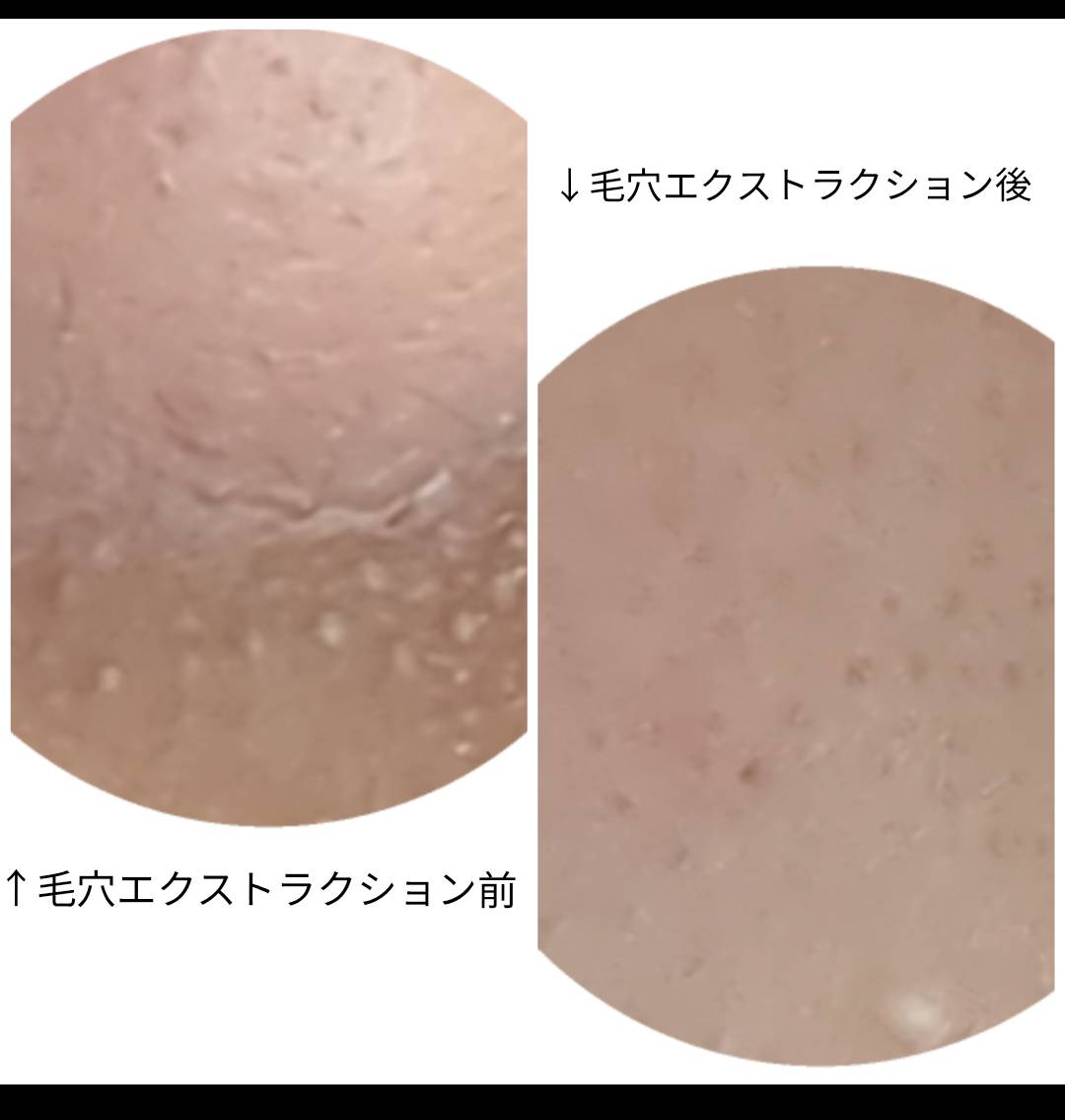 施術後のアフターケア